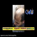 عکس ترمیم مو کاشت مو و روش ترمیم مو های فیکس آلمان