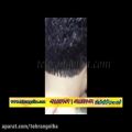 عکس ترمیم مو کاشت مو و روش ترمیم مو های فیکس آلمان