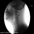 عکس به کمک اشعه ی ایکس ببینید چطور غذا و آب از گلوی یک انسان پایین می رود.